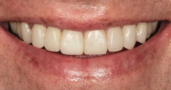 The image displays a close-up of a person with a wide smile showing white teeth, wearing lipstick, with a visible mole on the right cheek area.