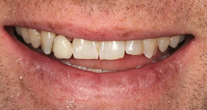 The image shows a person with an open mouth displaying a wide smile, revealing yellowed teeth and a partial denture.